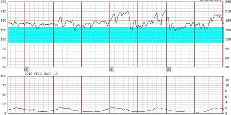 fetal monitor strips practice|Fetal monitor strip practice .